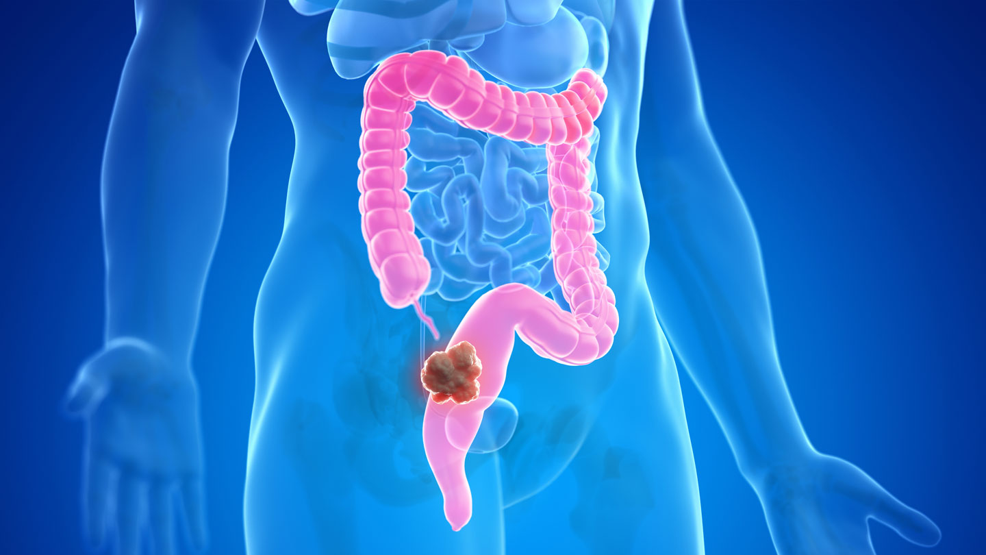 ¿Por qué más personas menores de 50 años tienen cáncer colorrectal?  Los científicos tienen algunas pistas.