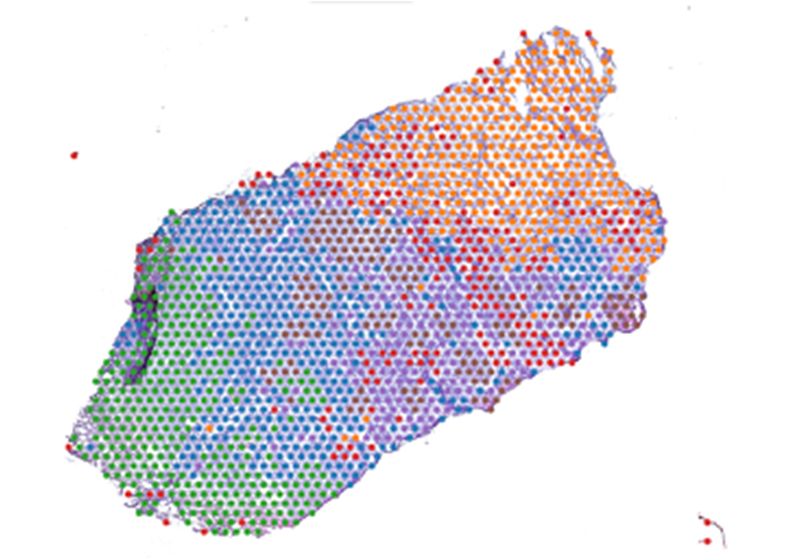 Los investigadores conectan el perfil transcripcional de vanguardia de un tumor con malos resultados de supervivencia en todos los tipos de cáncer.