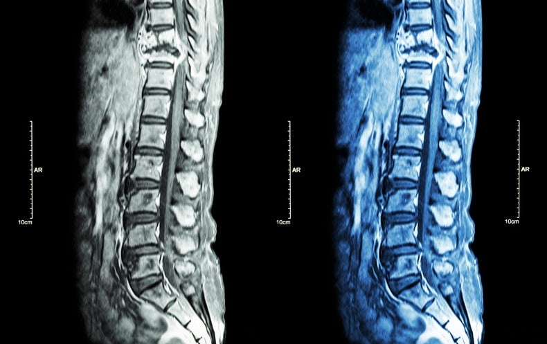 Una célula madre recién descubierta podría explicar cómo se propaga el cáncer de mama a la columna vertebral