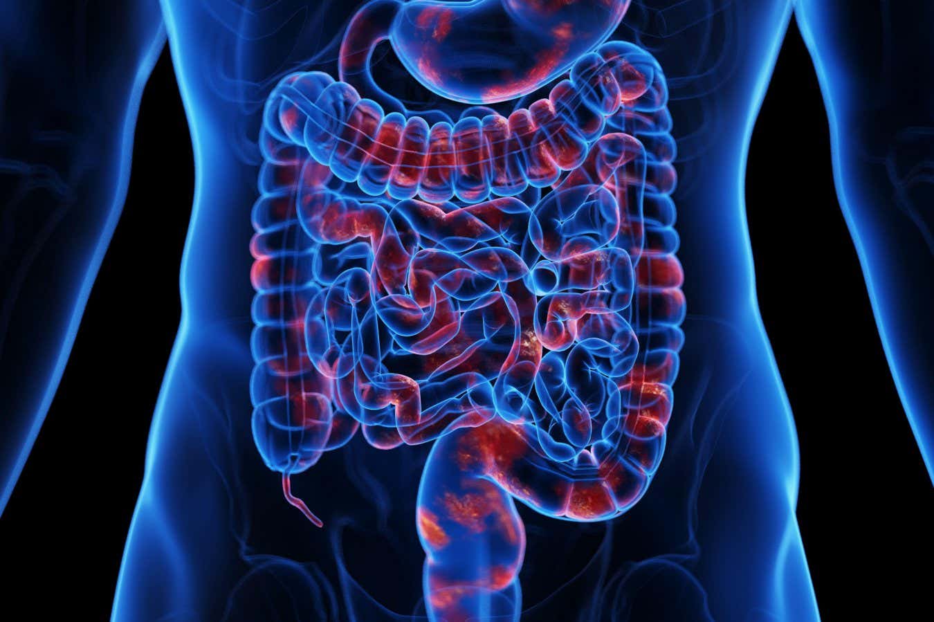 Las células inmunes clave pueden ayudar a proteger contra la enfermedad inflamatoria intestinal