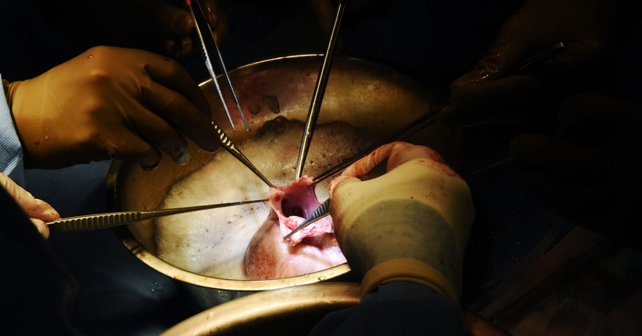 Cómo hacer que un trasplante de corazón de cerdo dure en una persona