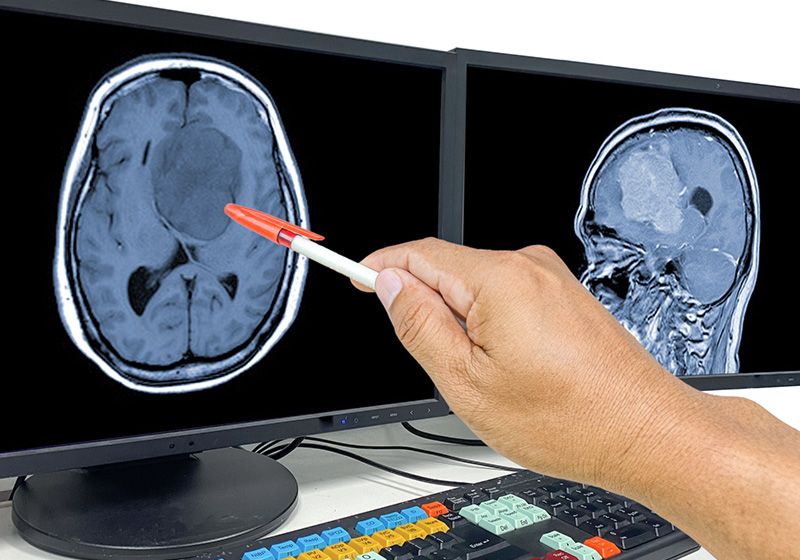 Aprendizaje automático para predecir el pronóstico del glioblastoma
