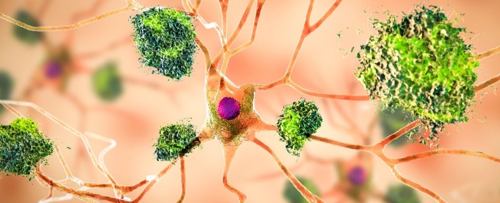 Las infecciones por hongos en el cerebro pueden causar síntomas similares a los del Alzheimer: ScienceAlert