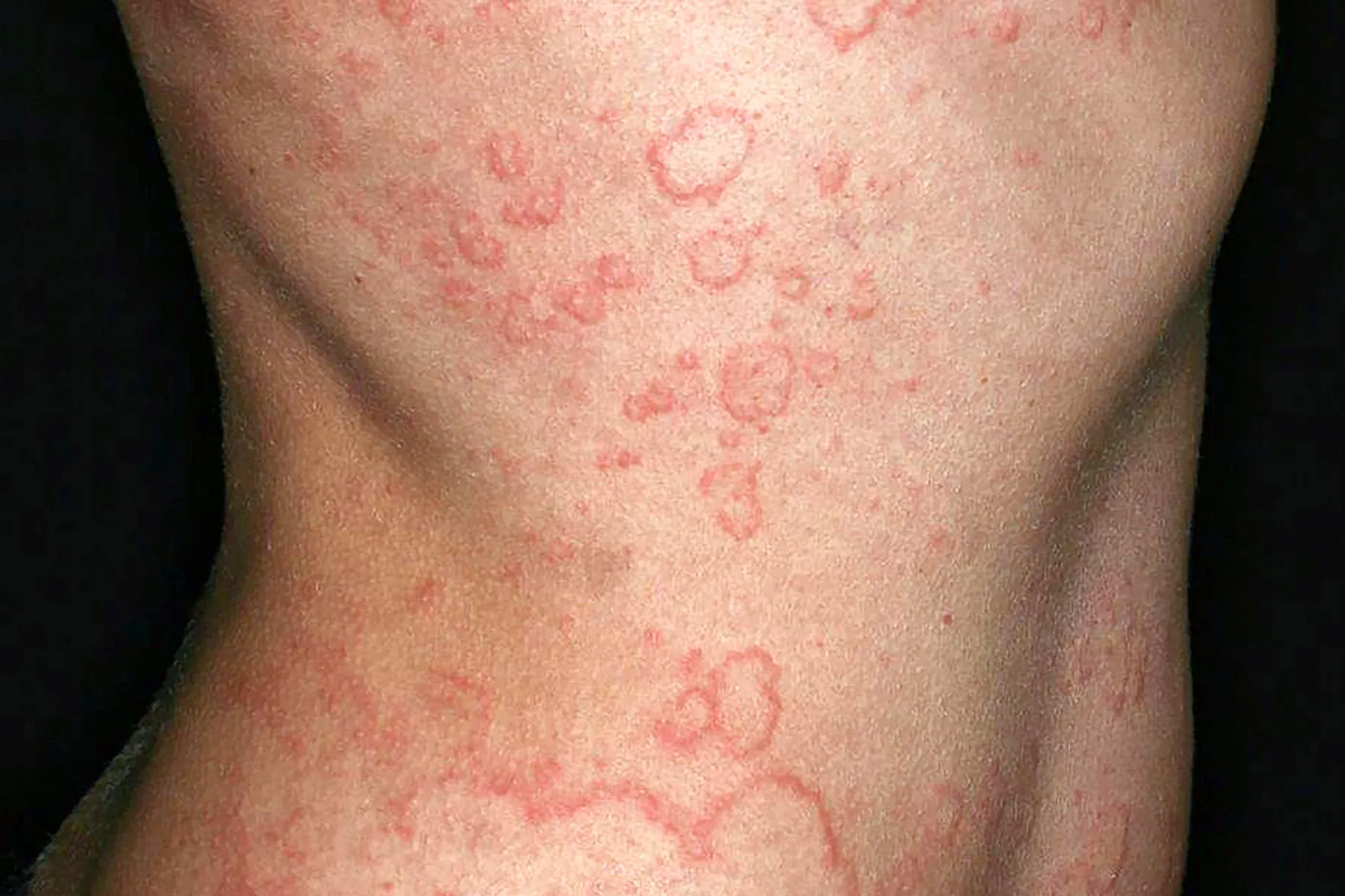 1800x1200 What Is Chronic Spontaneous Urticaria Or Csu Features.jpg