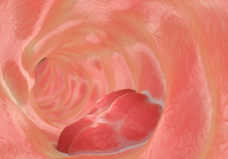 Biosensores para el cáncer colorrectal |  La revista científica®