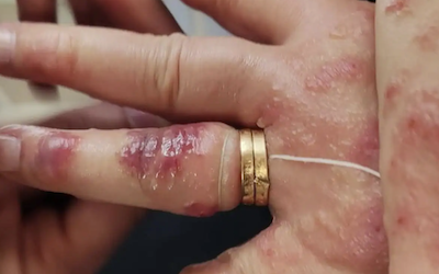 Anillos y dedos hinchados |  Noticias Gaceta Costa Tropical