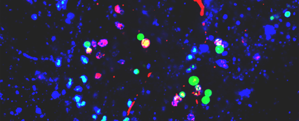 Nanoplásticos relacionados con cambios en las proteínas cerebrales asociadas con el Parkinson, según un estudio: ScienceAlert
