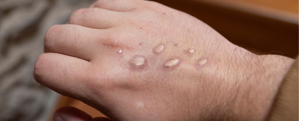 La ‘transmisión humana sostenida’ de Mpox ha estado ocurriendo durante más tiempo del que pensábamos: ScienceAlert