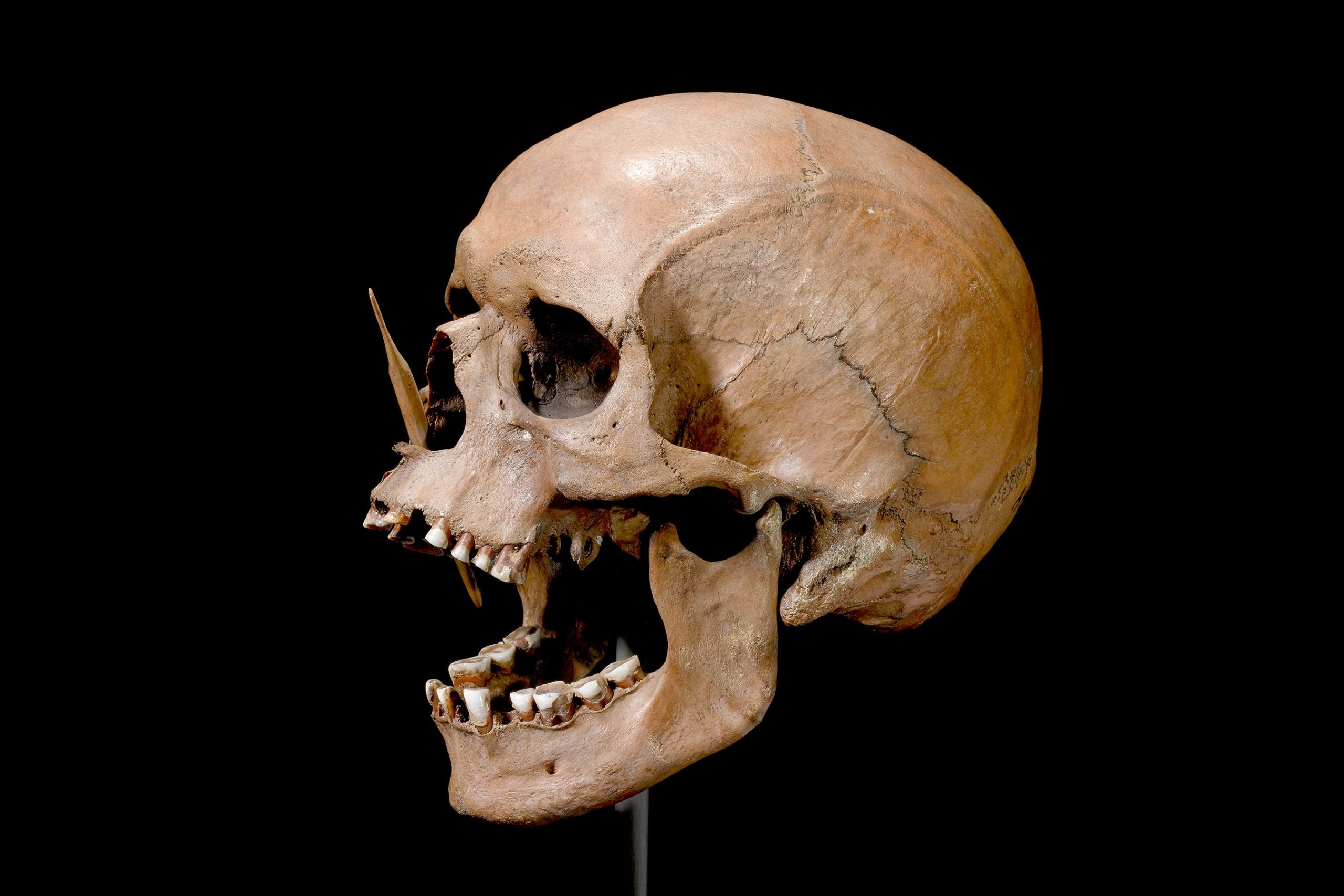 ADN antiguo revela los orígenes de la esclerosis múltiple en Europa