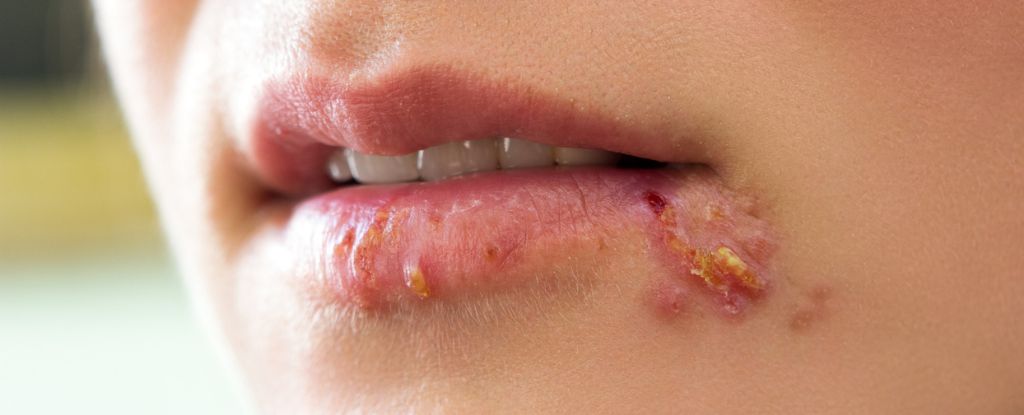 El virus del herpes puede duplicar el riesgo de demencia, según un estudio: ScienceAlert