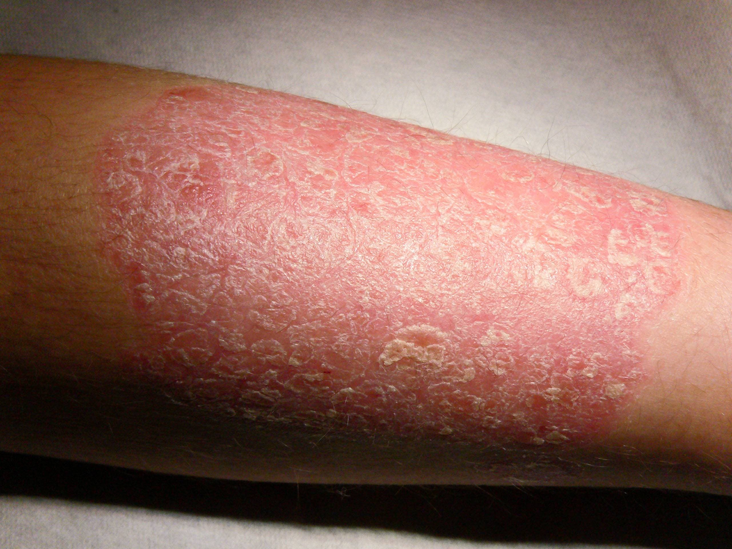 Los medicamentos para la psoriasis pueden reducir el riesgo de morir por enfermedades cardiovasculares y hepáticas, según un estudio realizado en España