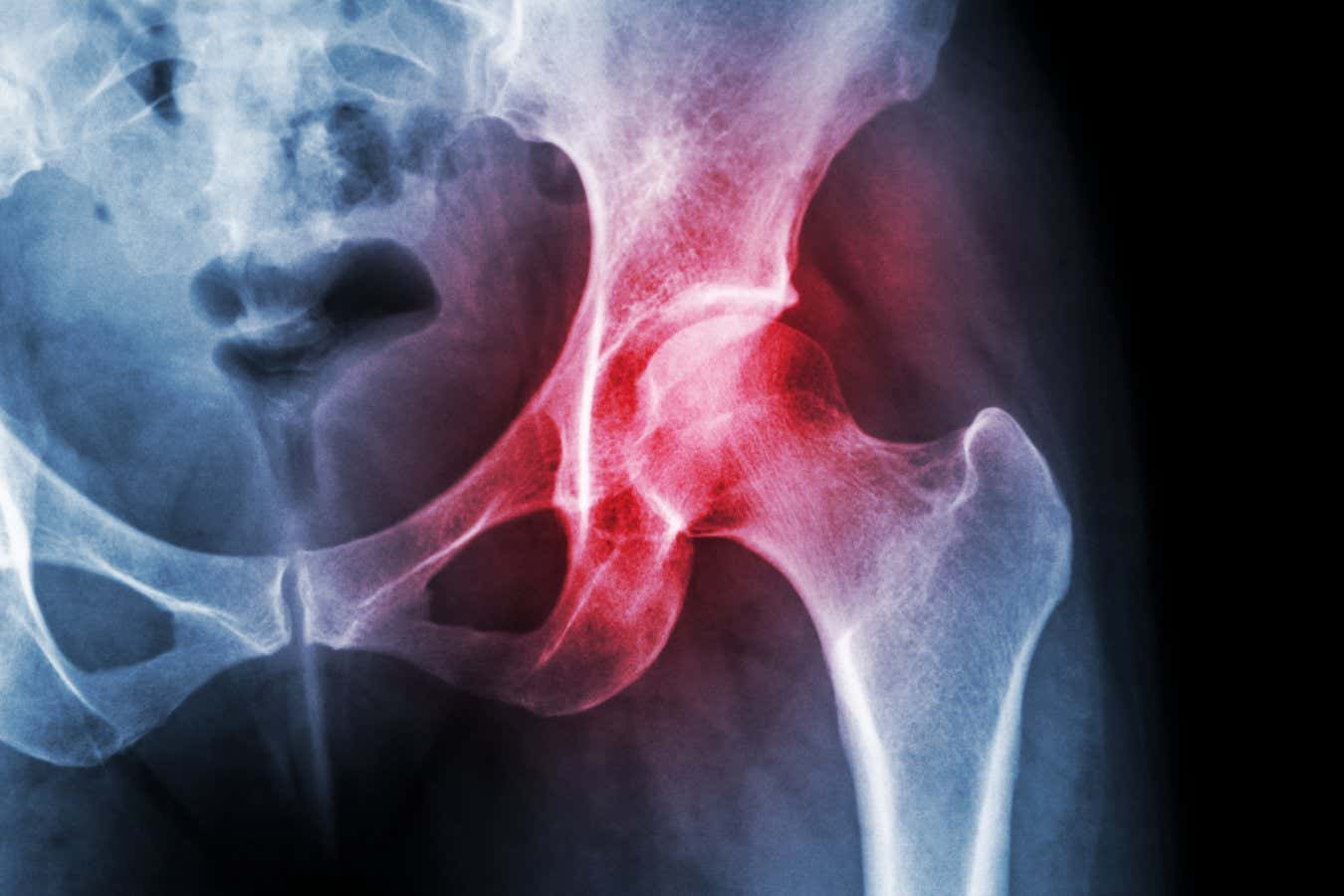 Las inyecciones de nanopartículas llenas de fármacos pueden aliviar el dolor de la artritis