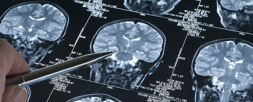 La pobreza puede acelerar el envejecimiento cerebral, según un estudio : ScienceAlert