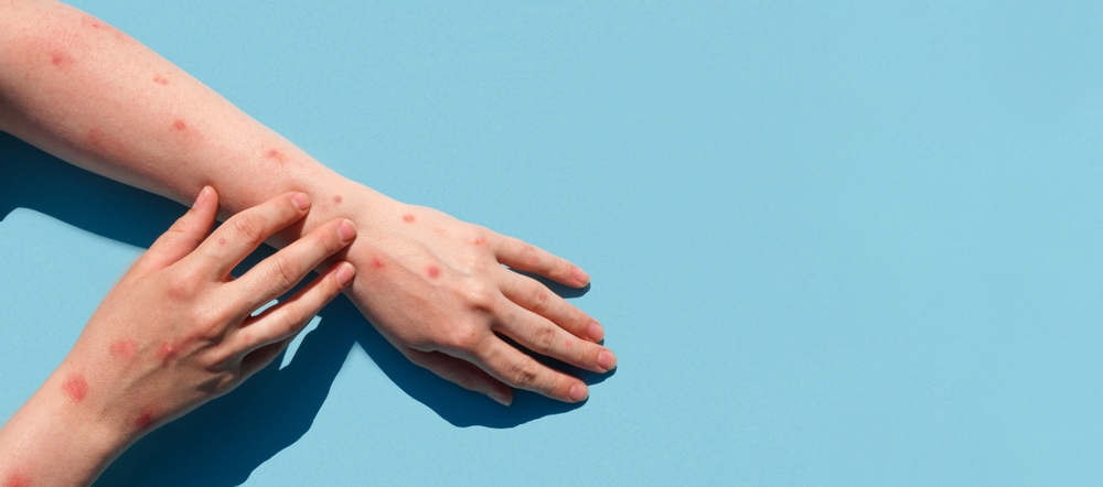 ¿Qué es la viruela del mono y deberíamos seguir preocupándonos por este virus?