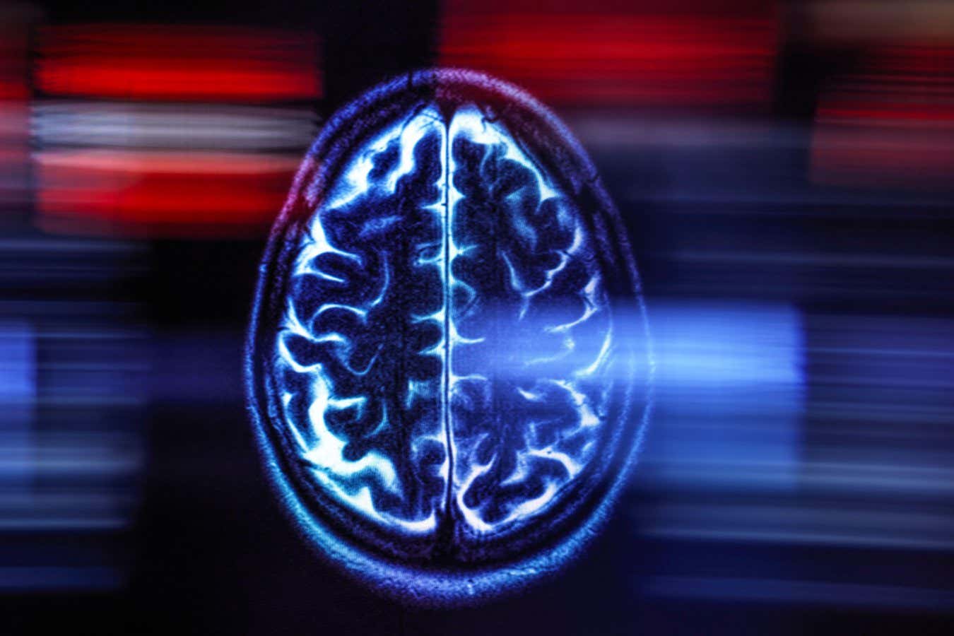 El Alzheimer puede ser causado por una acumulación de grasa en las células cerebrales