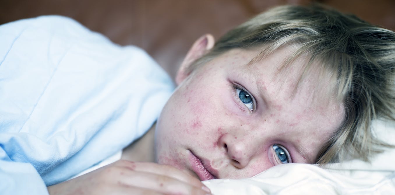 El sarampión es mortal y altamente contagioso, pero también fácilmente prevenible