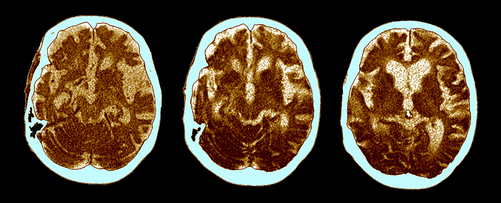 La causa oculta del Alzheimer pudo haber sido identificada hace un siglo: ScienceAlert