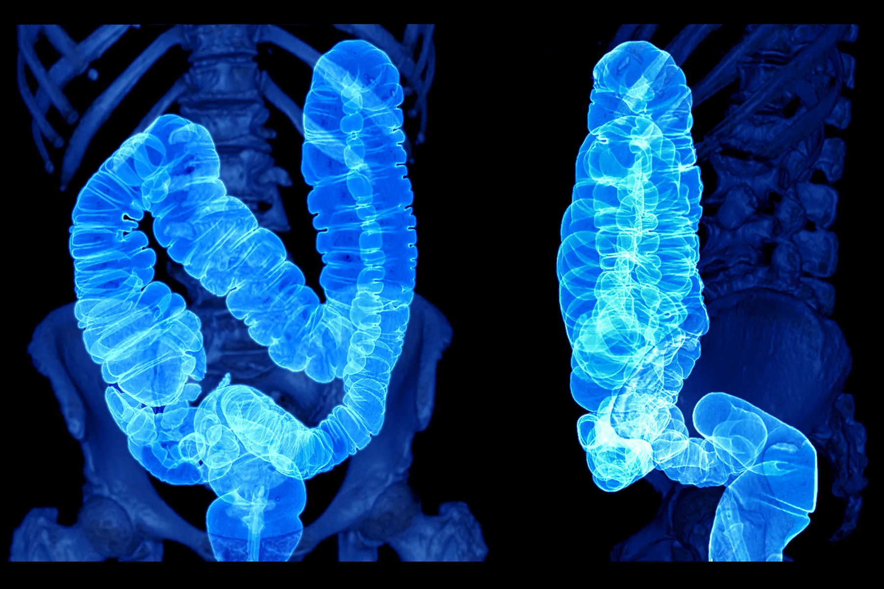 Detrás del aumento del cáncer colorrectal entre los jóvenes estadounidenses