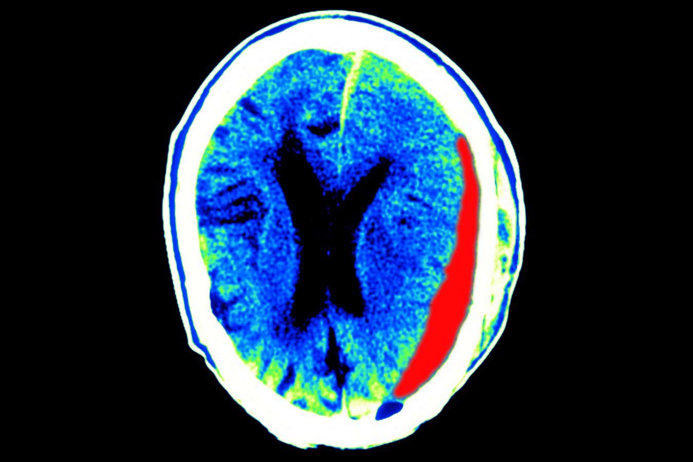 Algunos pacientes con lesión cerebral se recuperarían si no se terminara el soporte vital