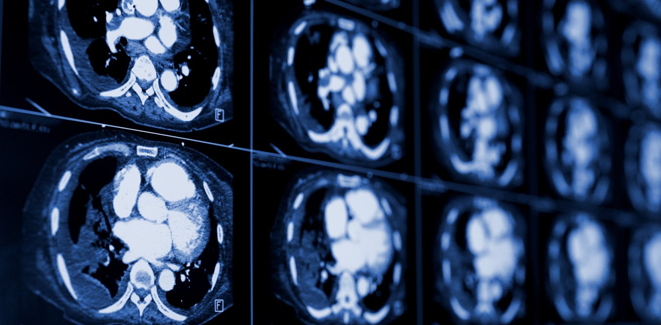 El cáncer de pulmón es el más mortífero; los exámenes de detección podrían salvar muchas vidas