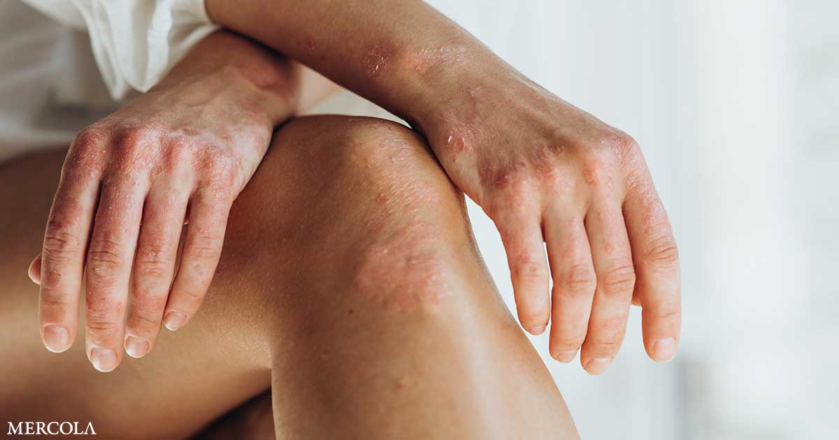 El aloe vera es eficaz para la mayoría de las psoriasis