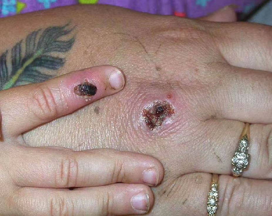 ¿Qué es el MPOX y cuántos casos hay en España? Todo lo que debes saber tras la declaración de emergencia sanitaria internacional por parte de la OMS