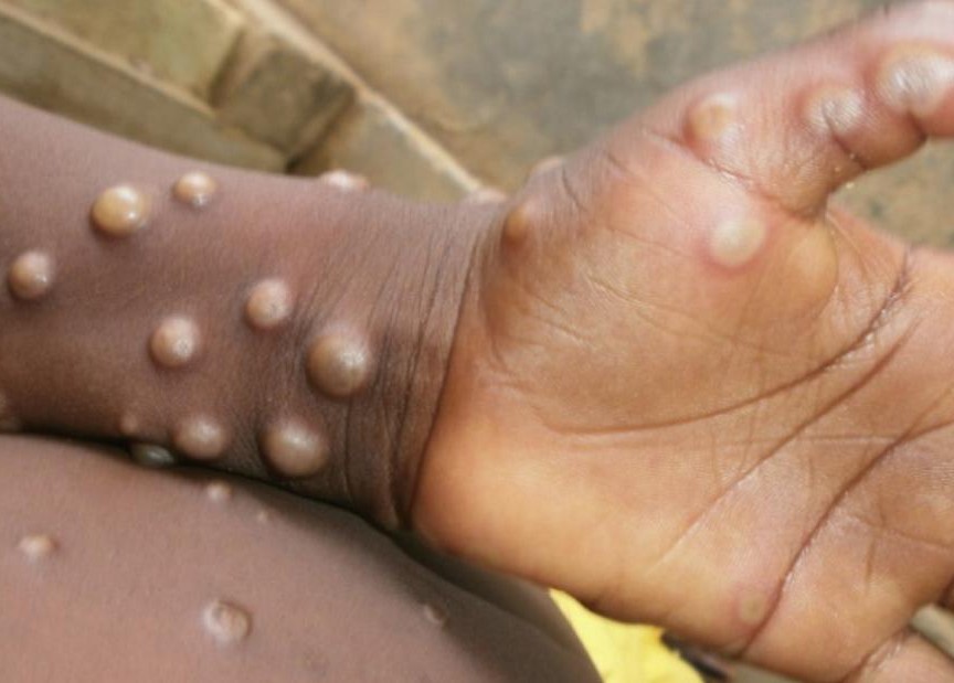 Exclusiva: A medida que aumentan los casos de Mpox, virus del Nilo Occidental y ahora fiebre perezosa en España, ¿cuánto deberíamos preocuparnos REALMENTE? Los expertos en salud dan su veredicto