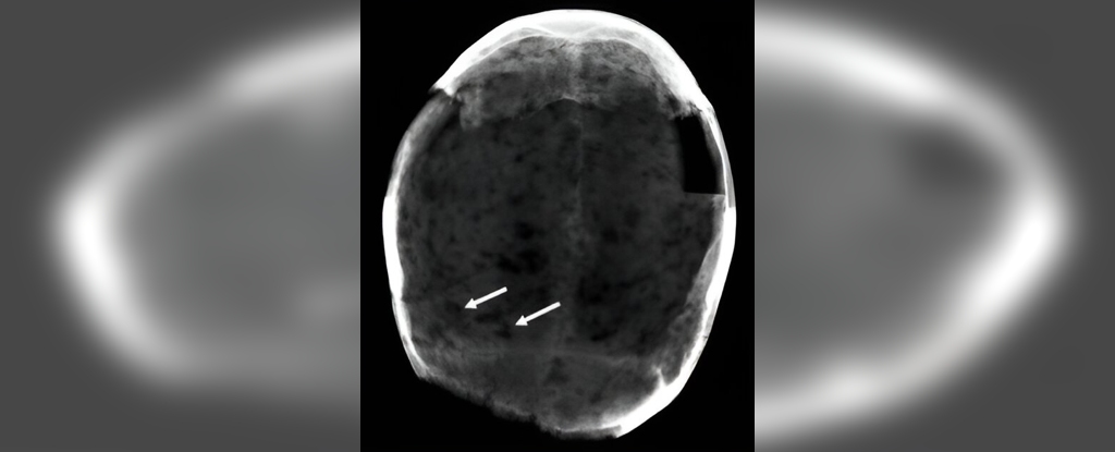 Cerebros momificados encontrados en una cripta muestran sorprendentes rastros de cocaína: ScienceAlert