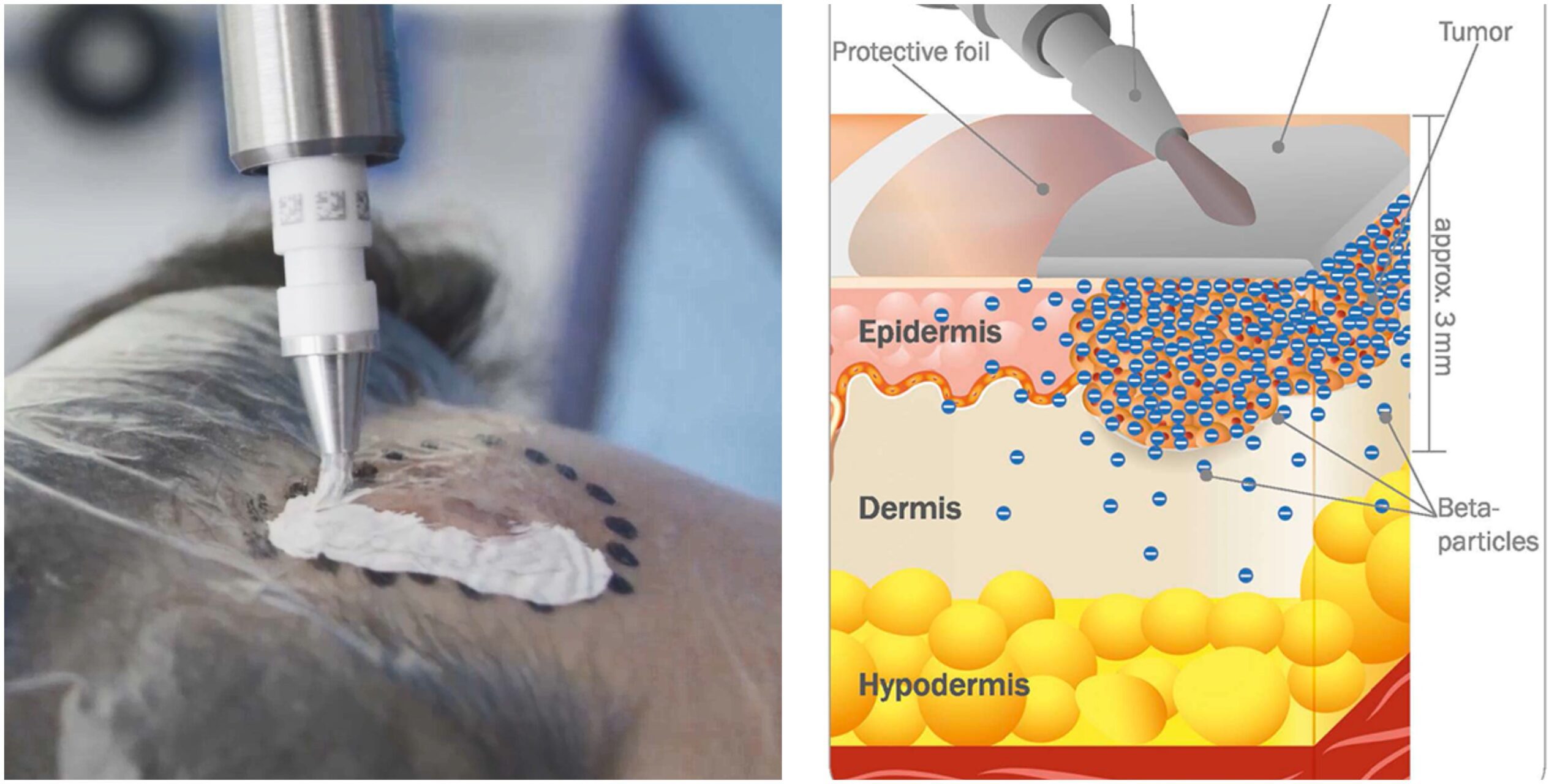 Un innovador tratamiento contra el cáncer de piel llega a España con una curación “sin cicatrices” y unas tasas de remisión del 89%