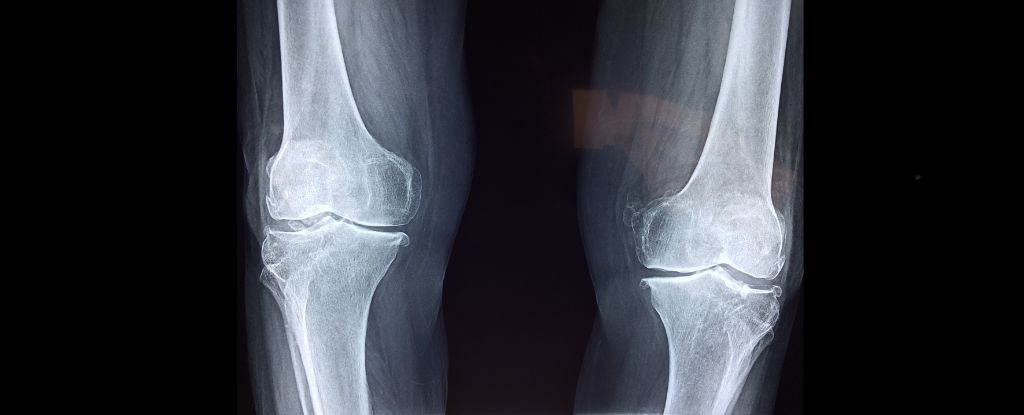 La osteoporosis es un “asesino silencioso”. He aquí cómo evitarlo. : Alerta científica