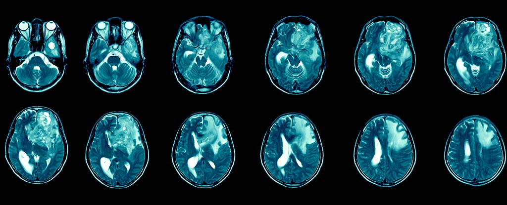 El tipo más mortal de cáncer cerebral puede tener un nuevo tratamiento prometedor: ScienceAlert