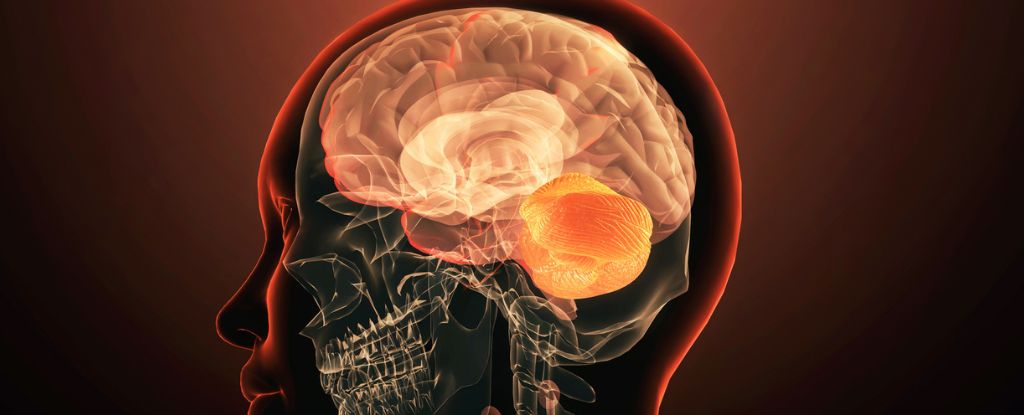 Un gen perdido que deforma el cráneo podría plantar las semillas de la esquizofrenia: ScienceAlert