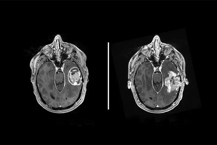 Los tumores cerebrales secuestran el reloj del cuerpo para impulsar el crecimiento