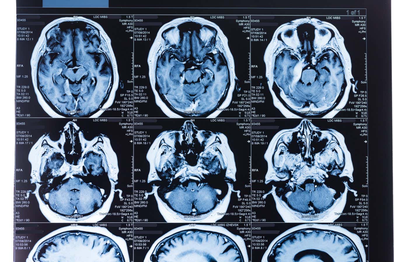 Trece proteínas en tu sangre podrían revelar la edad de tu cerebro