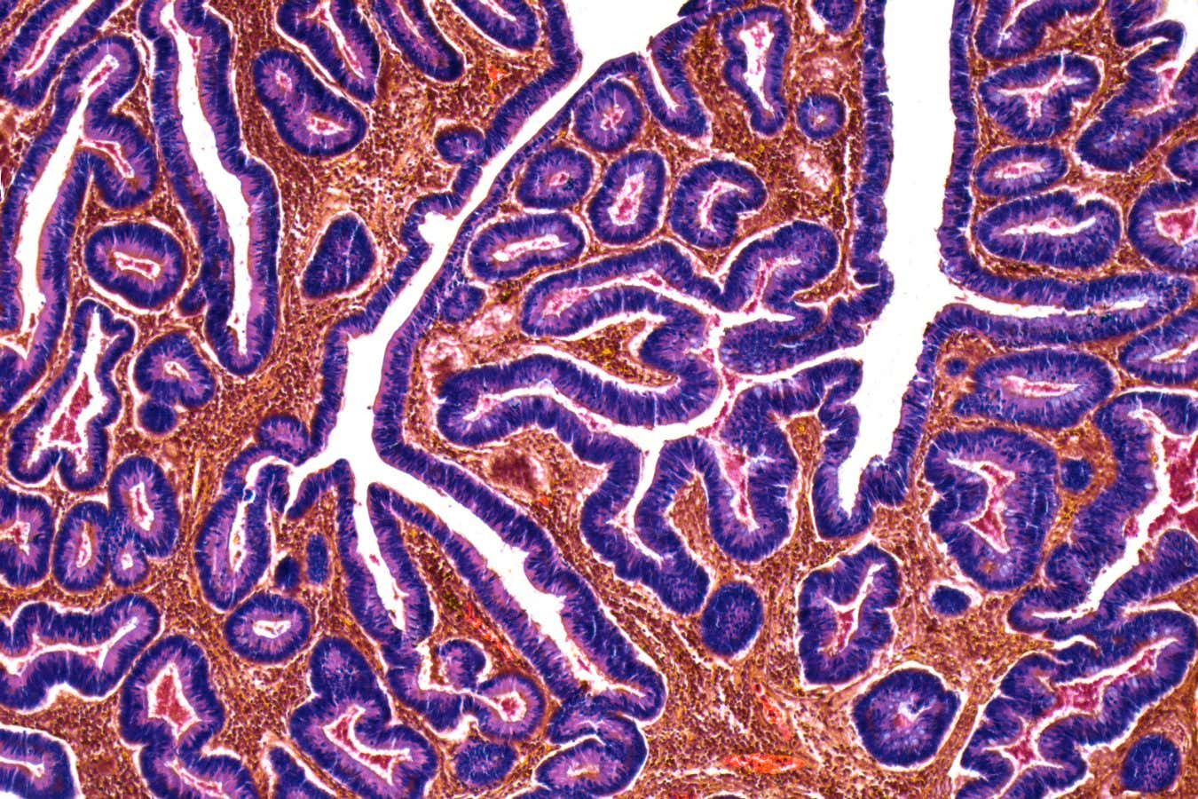 El cáncer de intestino está aumentando entre los jóvenes de todo el mundo