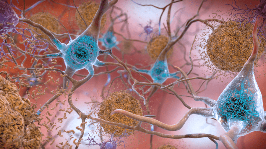 Una nueva vacuna de nanofibras tiene como objetivo prevenir la demencia sin inflamación