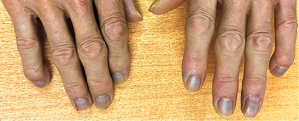 El extraño caso de un hombre cuya piel se volvió gris sigue siendo un misterio: ScienceAlert