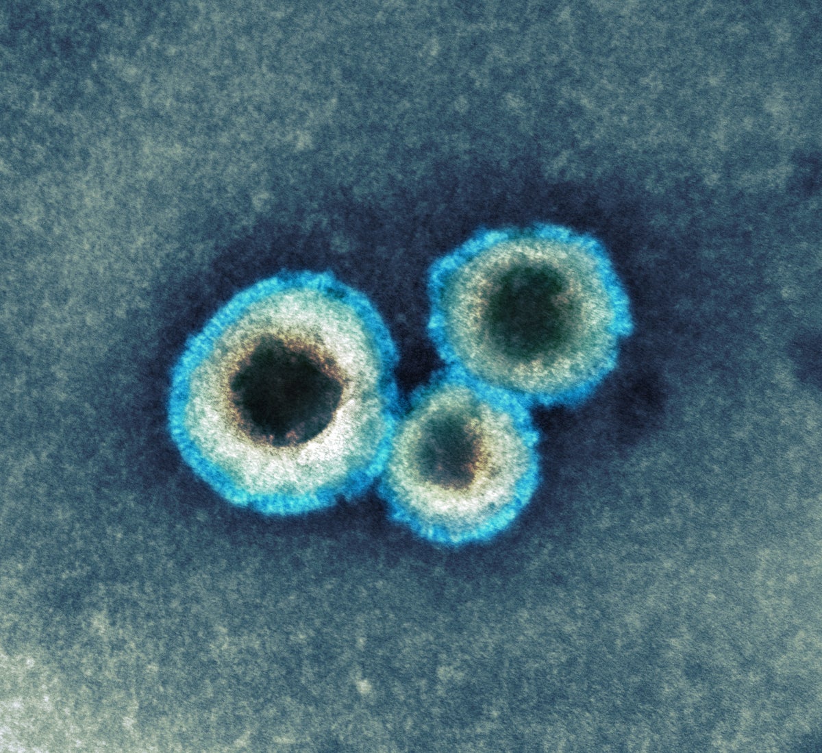 ¿Qué es el metapneumovirus humano y por qué están aumentando los casos en China?