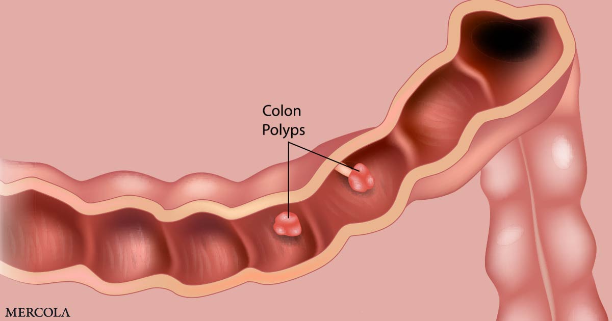 Síntomas de pólipos de colon para tener en cuenta