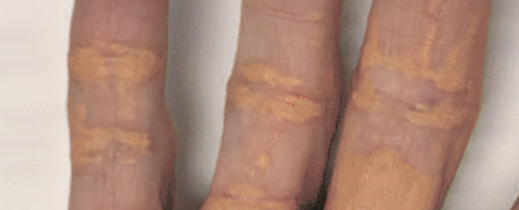 La dieta de carnívoro del hombre causa depósitos amarillos extraños en la piel: ciencias