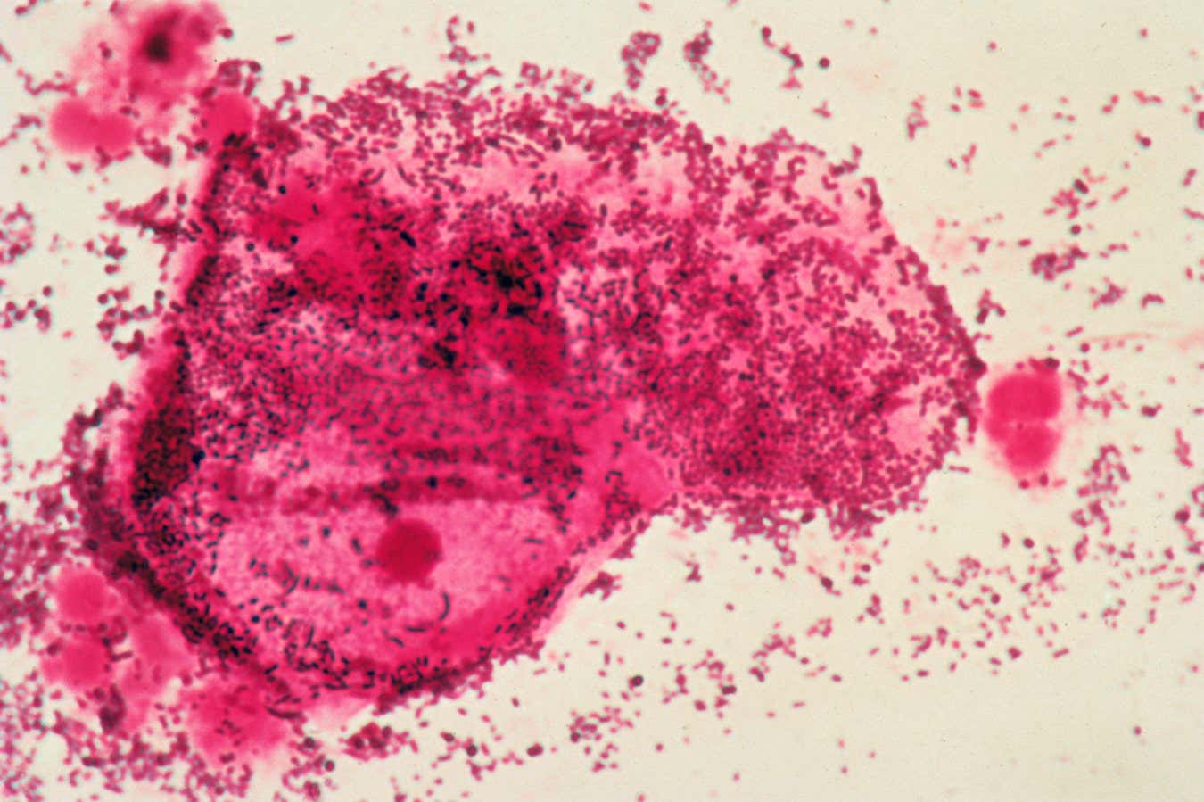 Los hombres que toman antibióticos podrían reducir las tasas de vaginosis bacteriana en las mujeres