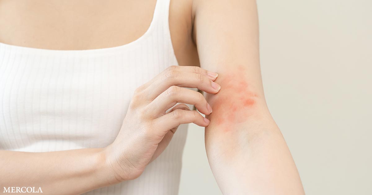 Dermatitis atópica vinculada a un mayor riesgo de hiperparatiroidismo