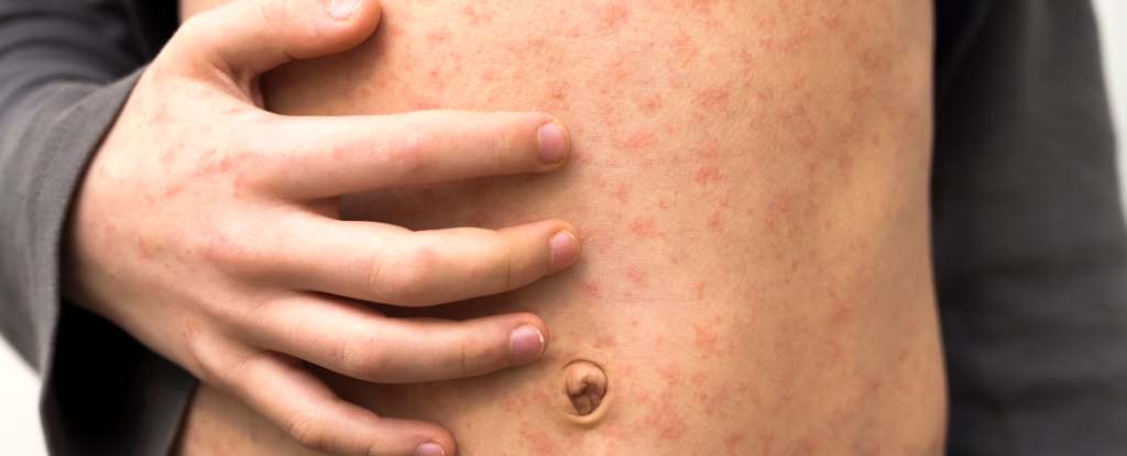 El sarampión devasta su cuerpo de varias maneras. Esto es lo que está en riesgo. : Sciencealert