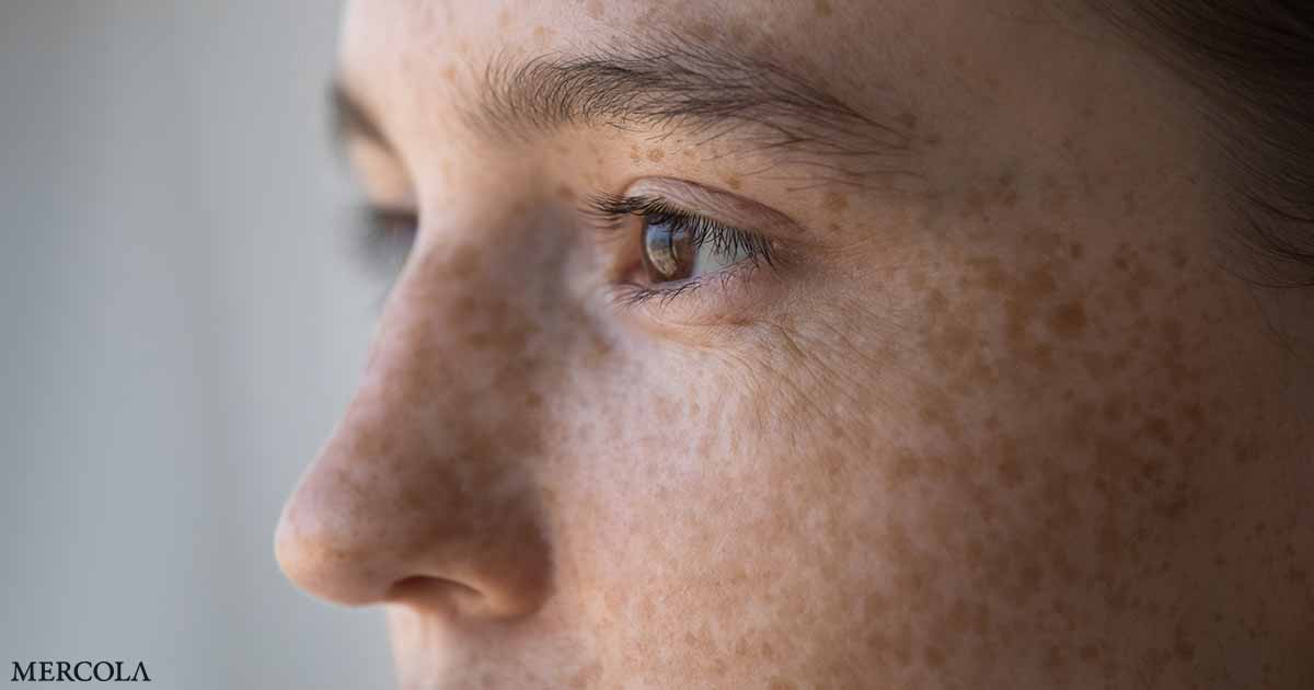 Cómo distinguir la diferencia entre pecas, manchas solares y lunares