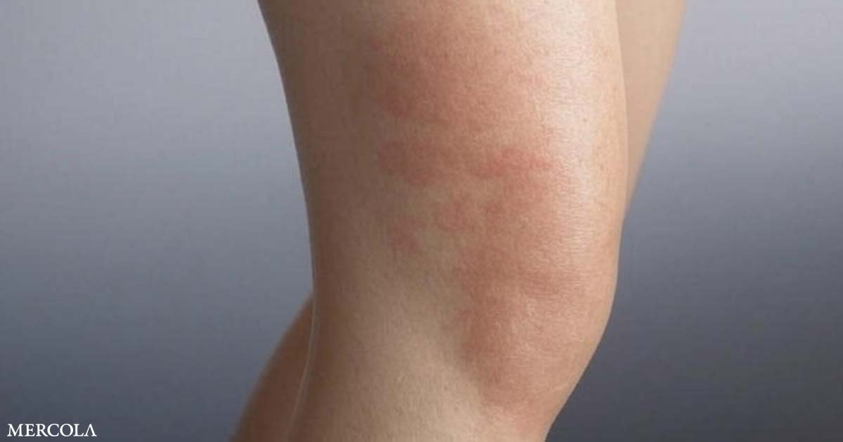 Calefacción y mantas vinculadas al ‘síndrome de la piel tostada’