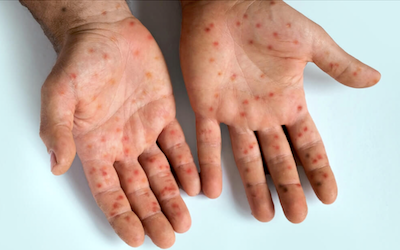 Casos de sarampión – Noticias de la Gaceta Tropical Costa