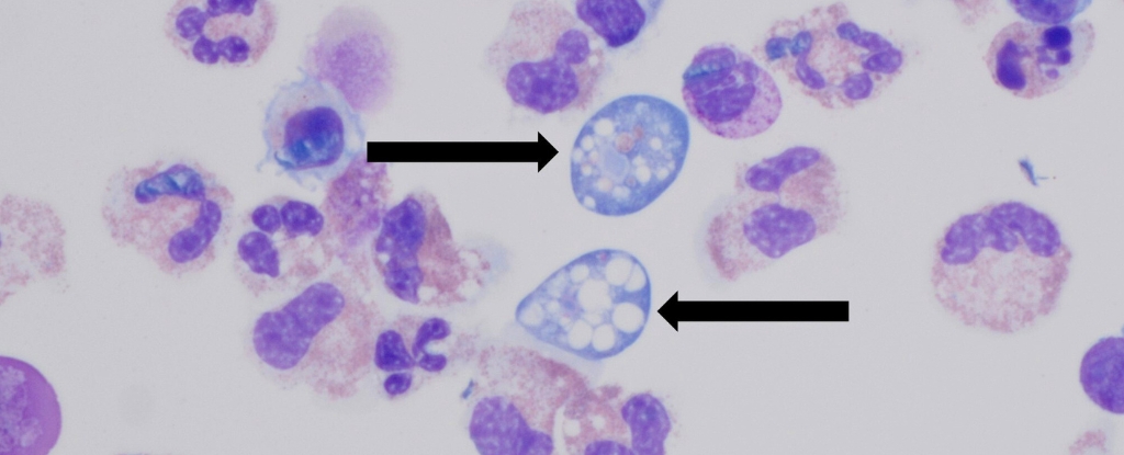 La mujer de Texas muere por la ameba que come cerebro después de los senos enrojecidos: Sciencealert