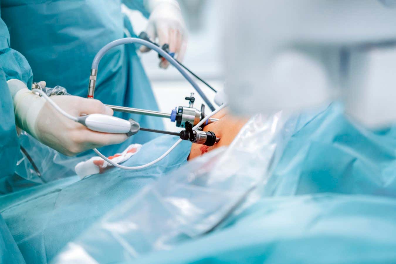 La cirugía de bypass gástrico puede reducir el riesgo de cáncer de intestino