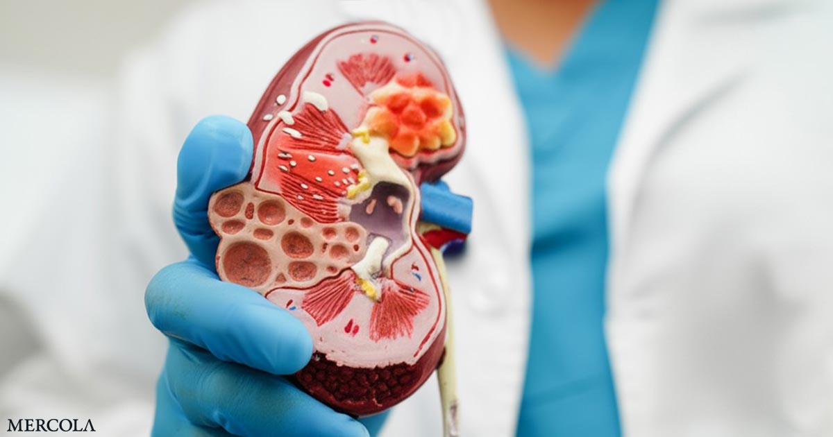 ¿Podría la baja testosterona conducir en secreto su riesgo de piedra renal?