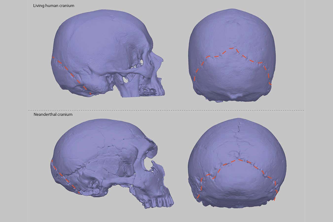 Un cráneo en forma de neandertal puede explicar por qué algunas personas tienen dolores de cabeza